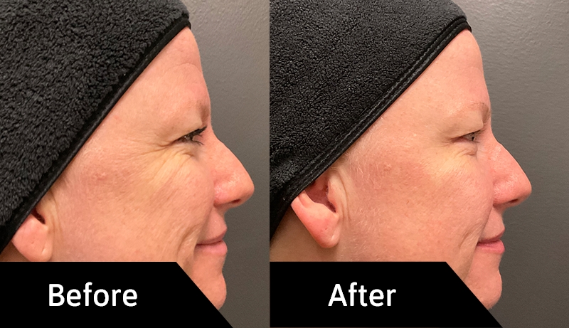 Before and After Natural Facial Rejuvenation