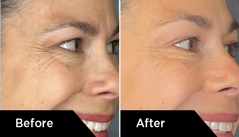 Botox before and after with fewer wrinkles