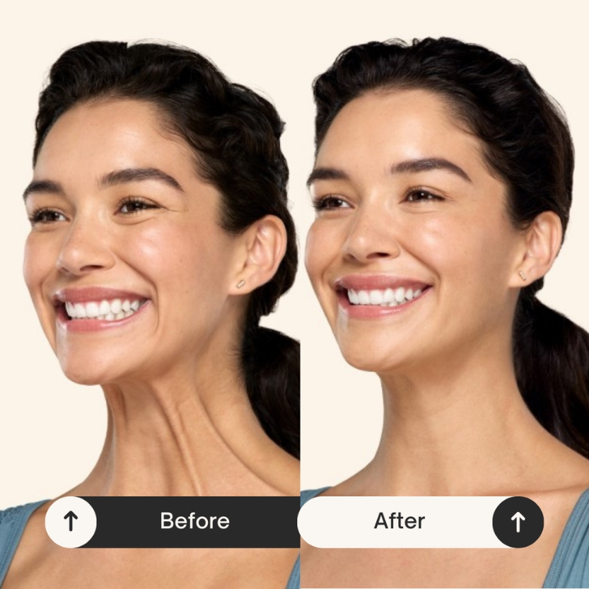 Before and after photo of woman's face after receiving botox